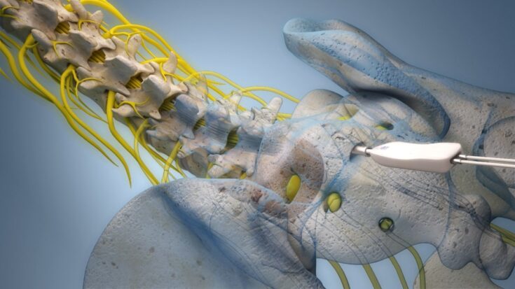 Epiduroskopi – behandling av ryggont orsakad  av sammanväxta ligament